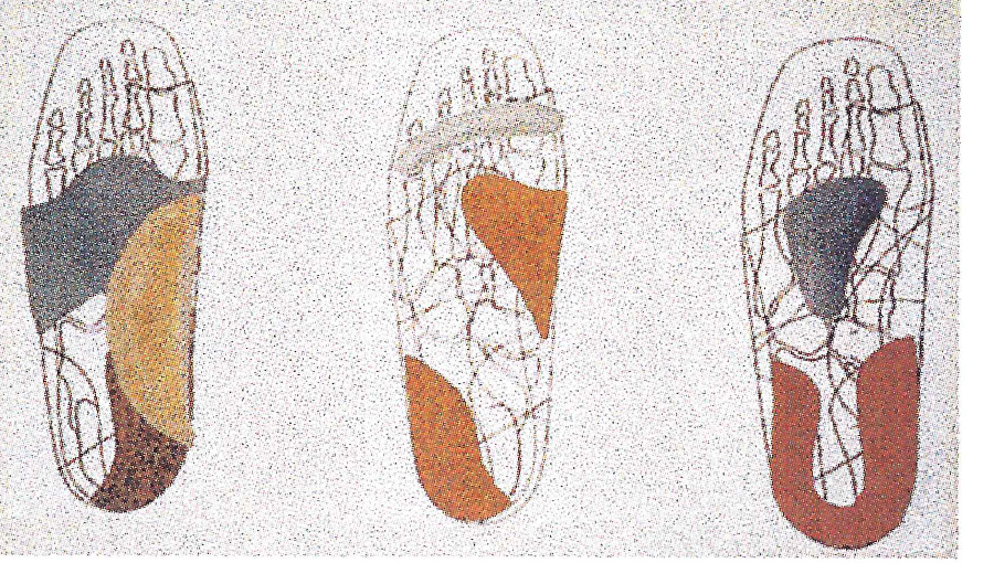 13_p2_ortheses_plantaires_schemas